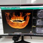 Моделирование имплантов