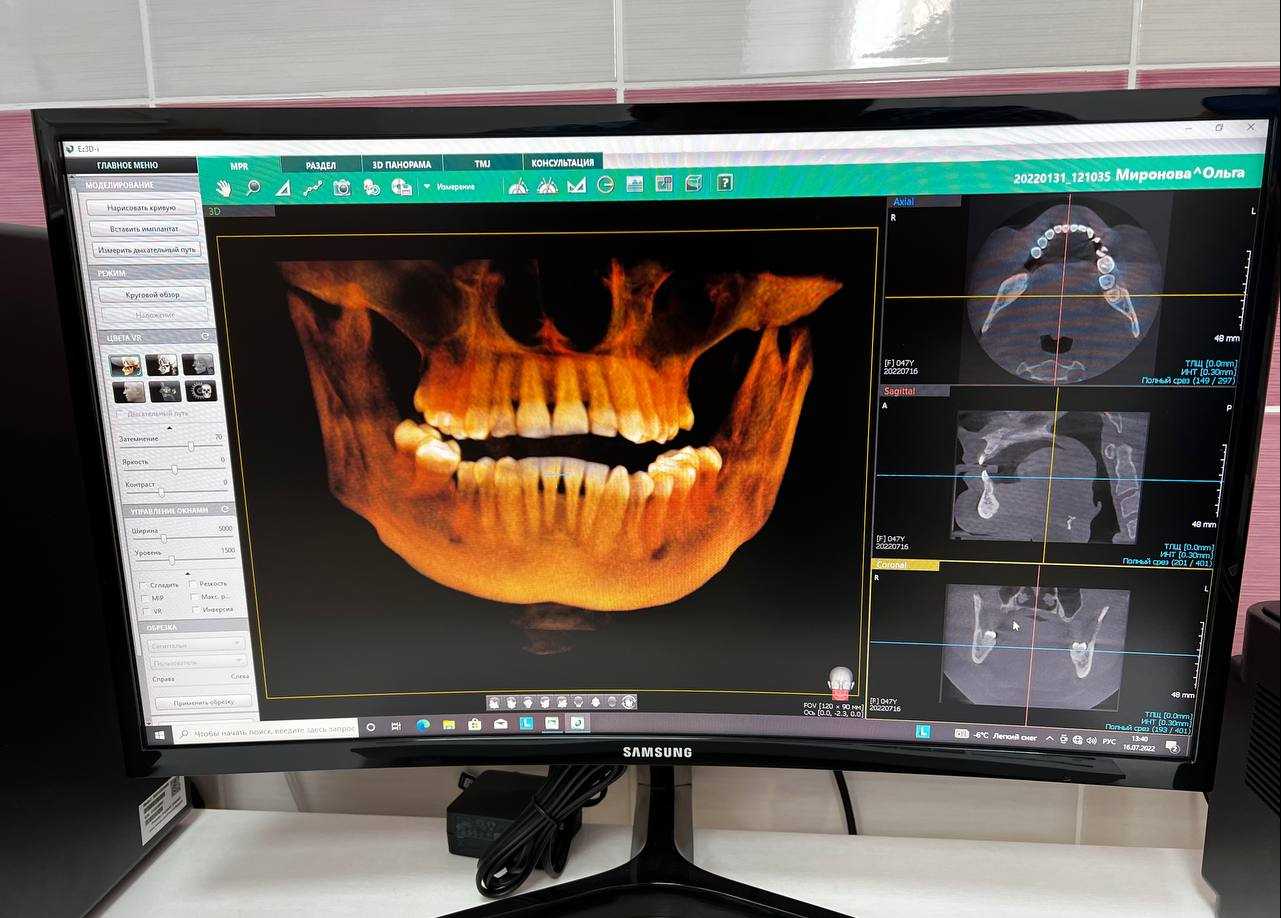 Моделирование имплантов