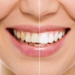 Отбеливание зубов
