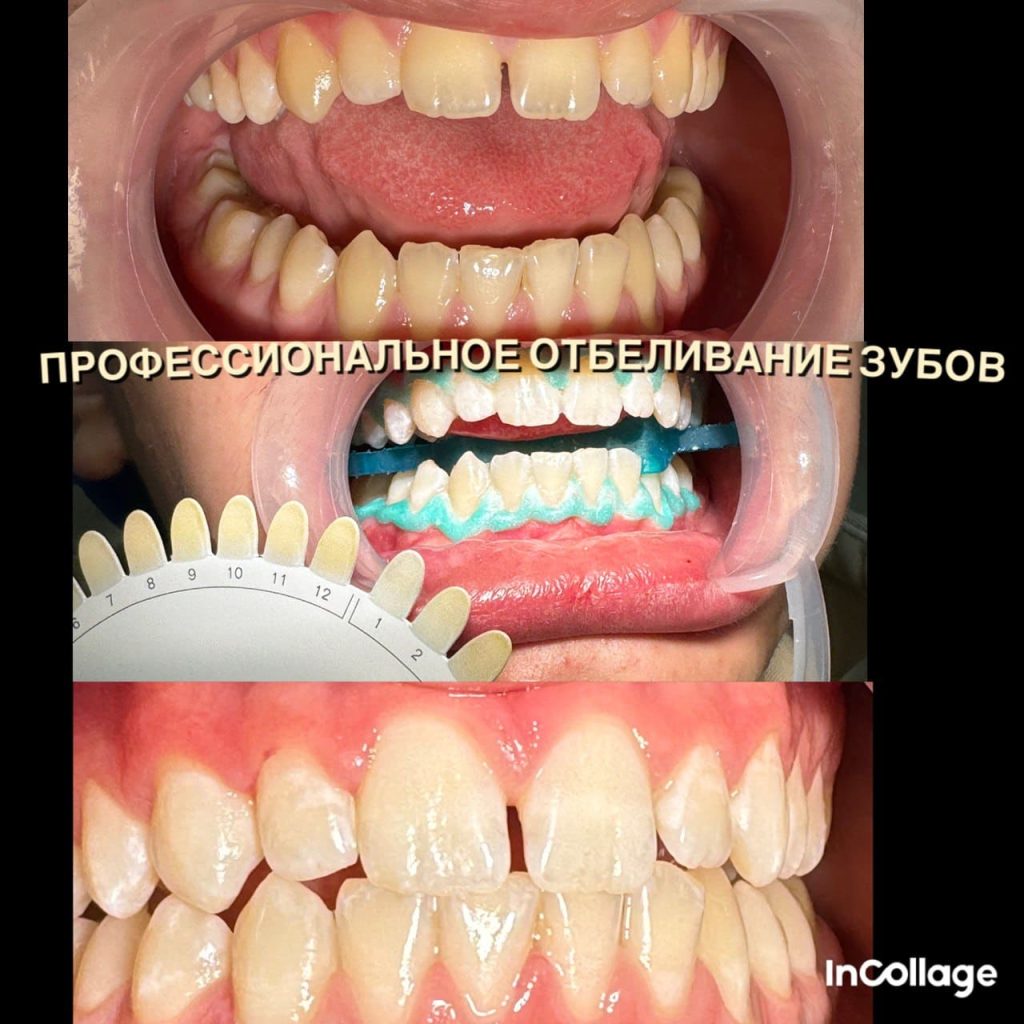 Отбеливание зубов